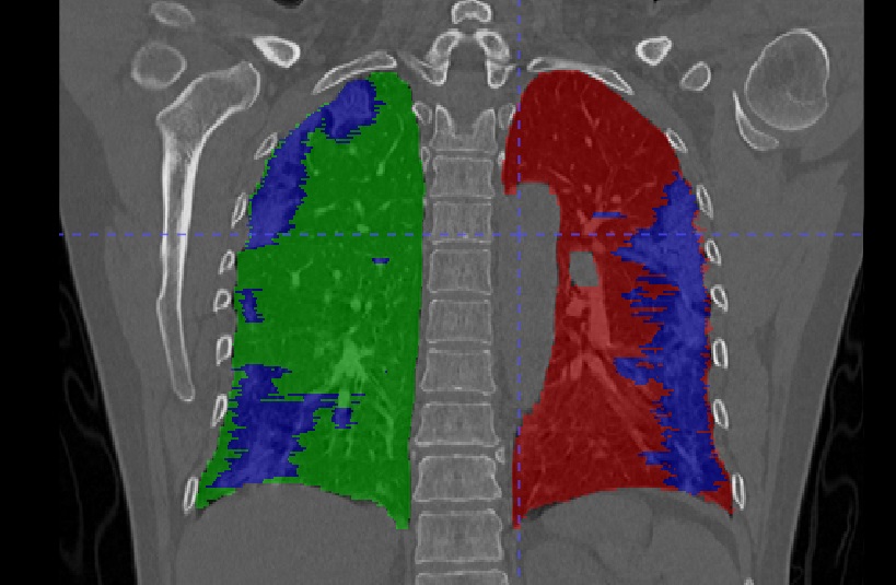 CT Scans