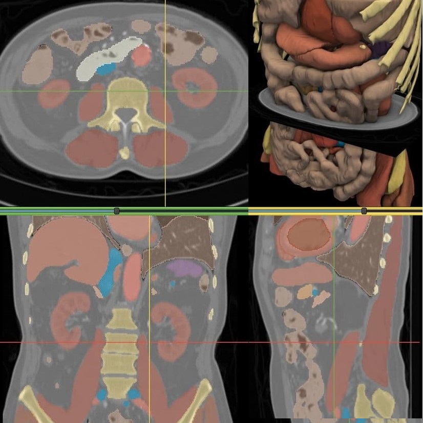 CT Scans