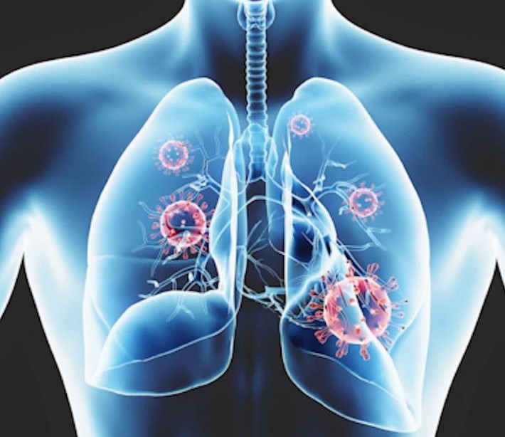 CT Scans